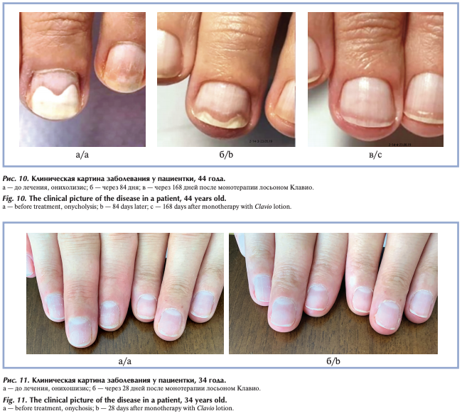Против онихолизиса. Ониходистрофия - онихолизис.. Болезнь ногтей ониходистрофия. Ониходистрофия ногтей клинические рекомендации. Псориатическая ониходистрофия.