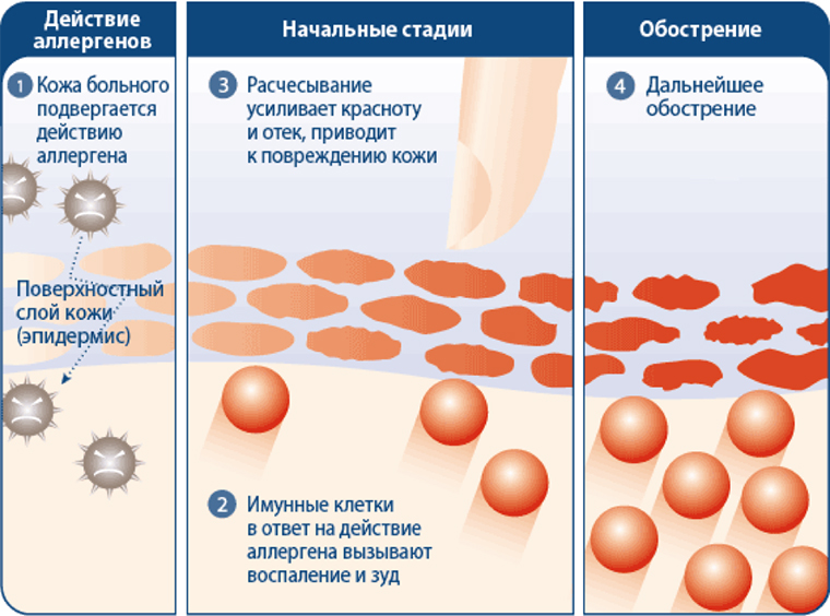 Стадии развития атопического дерматита