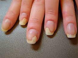 лечение ониходистрофии на ногтях рук